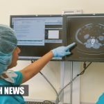 Netherlands Diabetics And Smokers Can Get Calcium Deposits In Their Brains