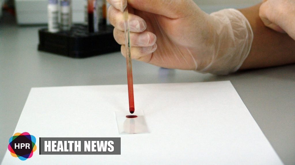 Inexpensive & Groundbreaking Blood Test Can Quickly Diagnose Hepatitis B patients In Africa