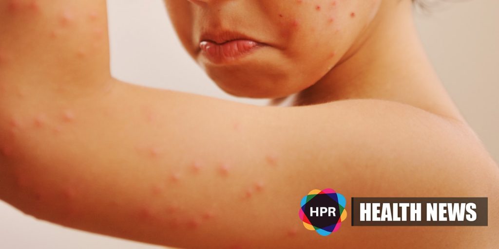 US FDA Approves First Drug To Treat Smallpox