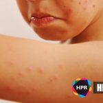 US FDA Approves First Drug To Treat Smallpox