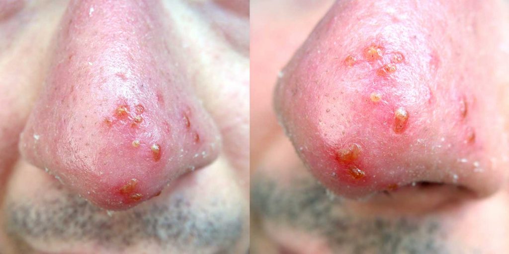 PID 3667 HPR - Neal Howard - Dr. Hugh McTavish - Herpes Simplex 1 and 2 Treatments