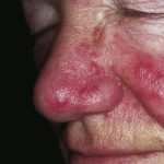 Dr.-James-Del-Rosso---ANSWER-Study-for-Treatment-of-Severe-Rosacea