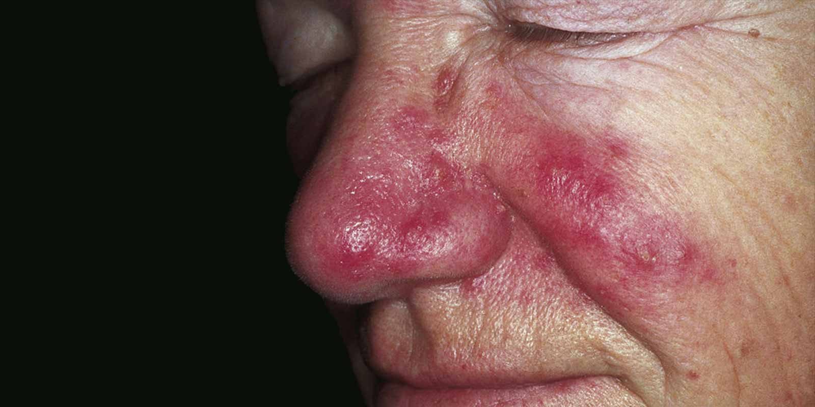 Study for treatment of patients with severe rosacea