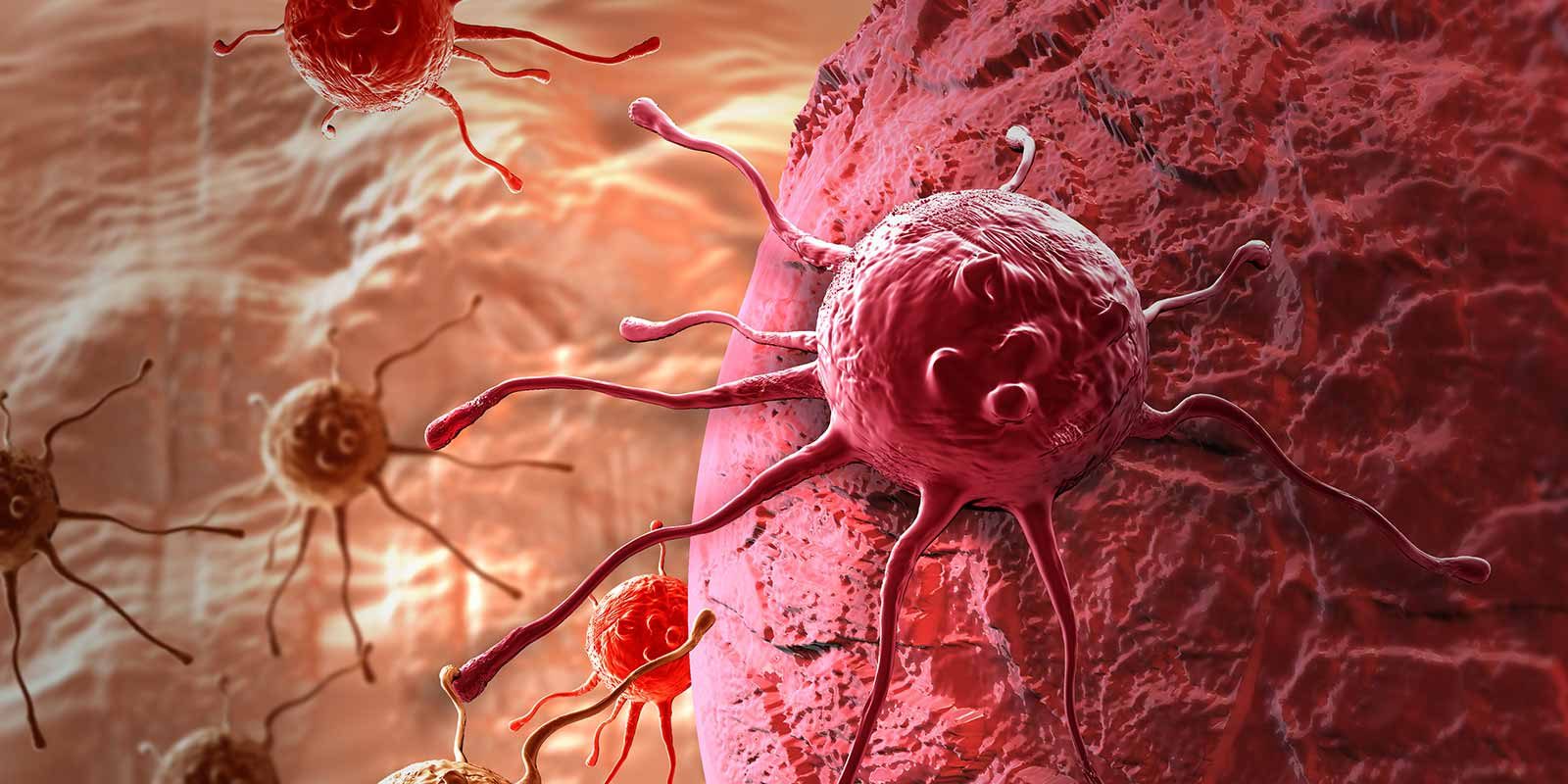 Salivary gland tumors, how genomic testing helps cure cancer