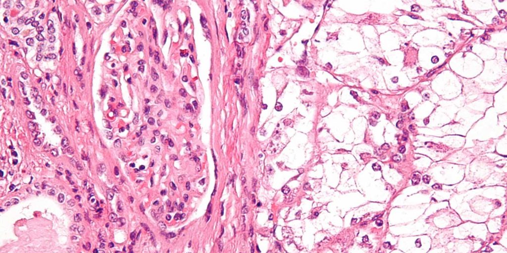 Dr.-Scot-Ebbinghaus---KEYTRUDA-for-Kidney-Cancer
