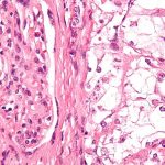 Dr.-Scot-Ebbinghaus---KEYTRUDA-for-Kidney-Cancer