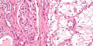 Dr.-Scot-Ebbinghaus---KEYTRUDA-for-Kidney-Cancer