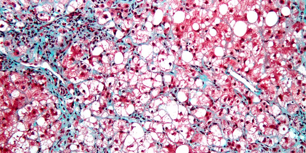 Terri-Milton---Nonalcoholic-Steatohepatitis