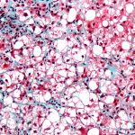 Terri-Milton---Nonalcoholic-Steatohepatitis