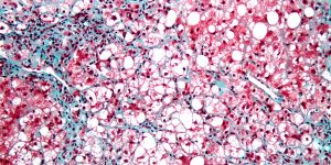Terri-Milton---Nonalcoholic-Steatohepatitis