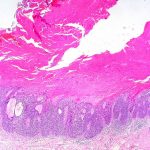 What-is-cutaneous-squamous-cell-carcinoma