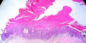 What-is-cutaneous-squamous-cell-carcinoma