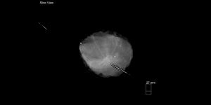 Kubtec-Tomosynthesis-System-for-Breast-Cancer-Imaging