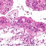 ESMO-2019-PAOLA-Trial
