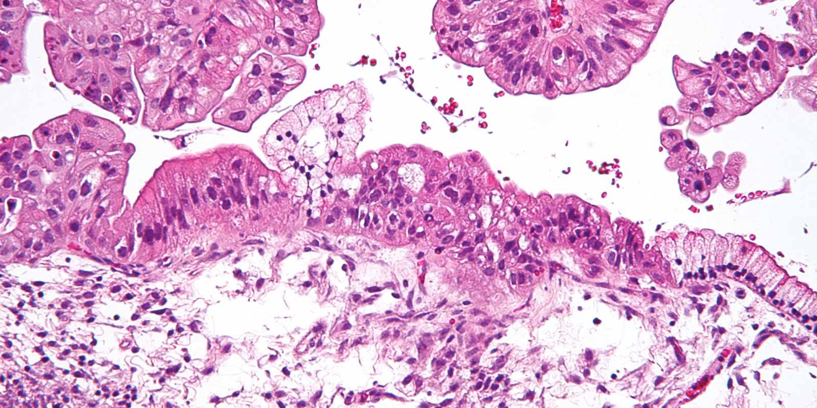 ESMO 2019 PAOLA Trial