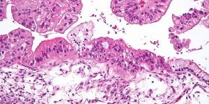 ESMO-2019-PAOLA-Trial