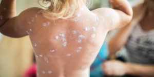 Health-Security-and-Smallpox-Potential