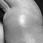 Uncontrolled-Gout-in-Kidney-Transplant-Patients
