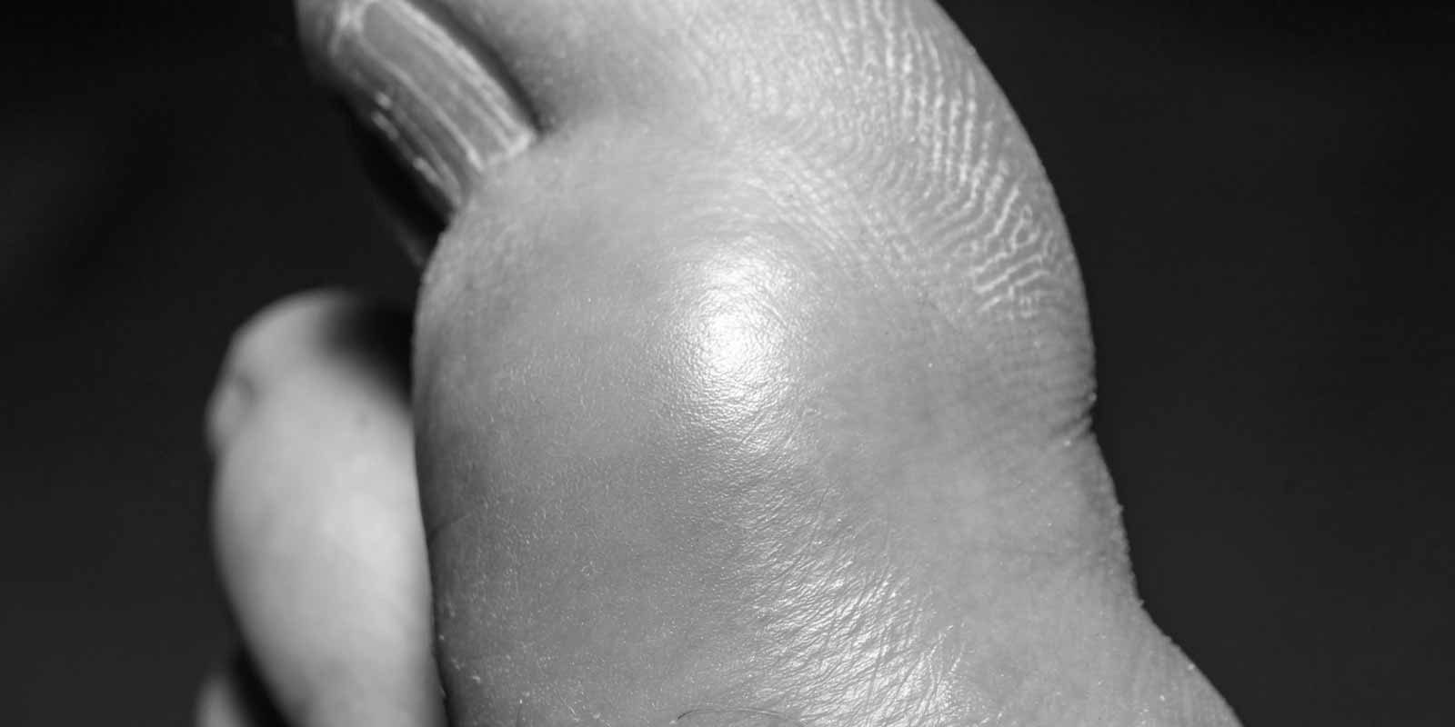 Uncontrolled Gout in Kidney Transplant Patients