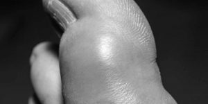Uncontrolled-Gout-in-Kidney-Transplant-Patients