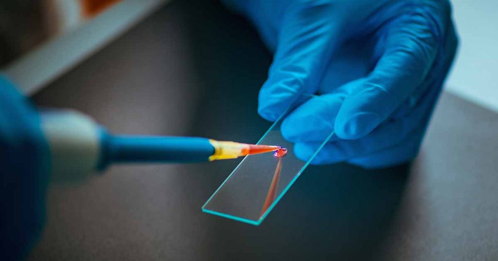 CareDX - Allosure Lung for Transplant Surveillance