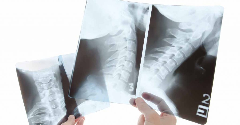 Q&A on Cervical Deformity: Indications for Combined Anterior and Posterior Approaches for Deformity