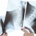 Q&A on Cervical Deformity: Indications for Combined Anterior and Posterior Approaches for Deformity