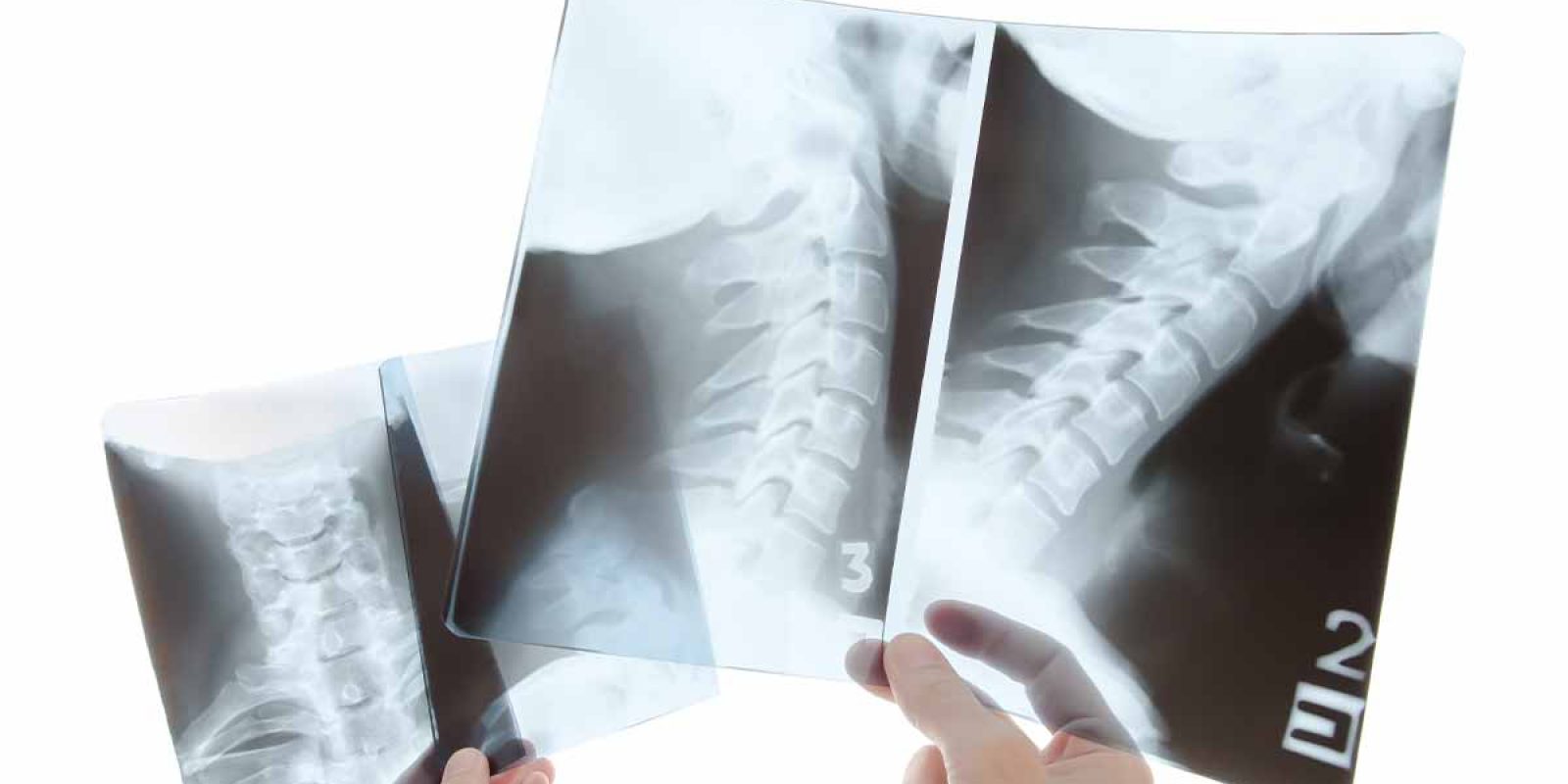 Q&A on Cervical Deformity: Indications for Combined Anterior and Posterior Approaches for Deformity