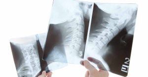 Q&A on Cervical Deformity: Indications for Combined Anterior and Posterior Approaches for Deformity