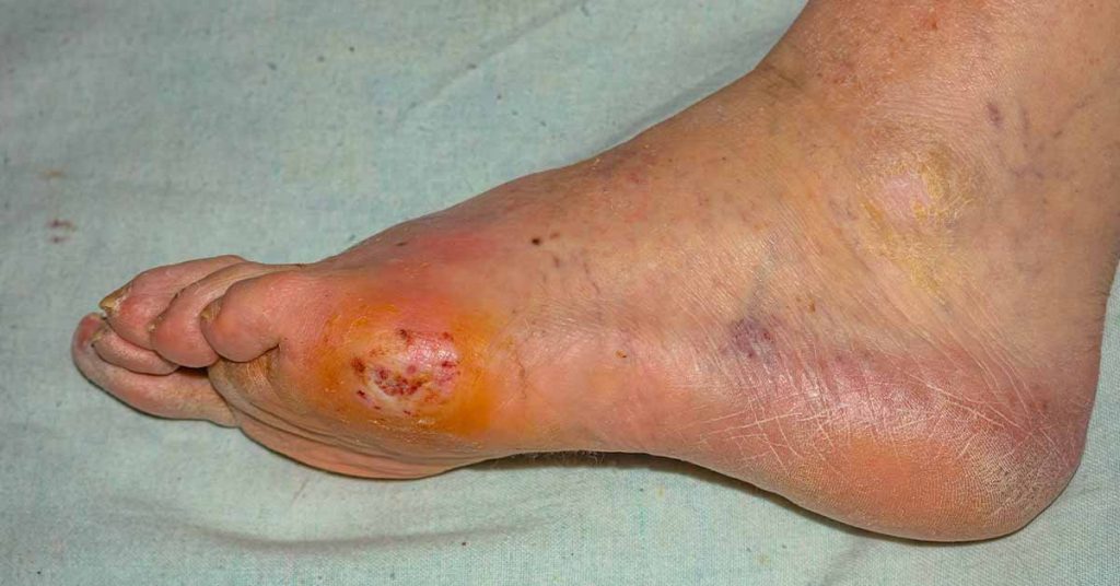 PolarityTE---Phase-III-Pivotal-Study-Evaluating-Investigational-New-Drug-SkinTE®-in-Diabetic-Foot-Ulcers