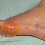 PolarityTE---Phase-III-Pivotal-Study-Evaluating-Investigational-New-Drug-SkinTE®-in-Diabetic-Foot-Ulcers
