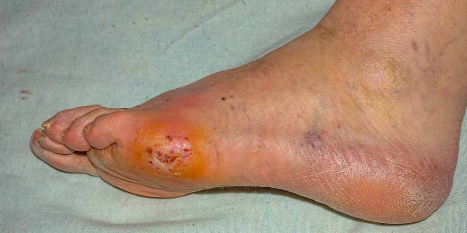 PolarityTE – Phase III Pivotal Study Evaluating Investigational New Drug SkinTE ® in Diabetic Foot Ulcers