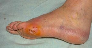 PolarityTE---Phase-III-Pivotal-Study-Evaluating-Investigational-New-Drug-SkinTE®-in-Diabetic-Foot-Ulcers