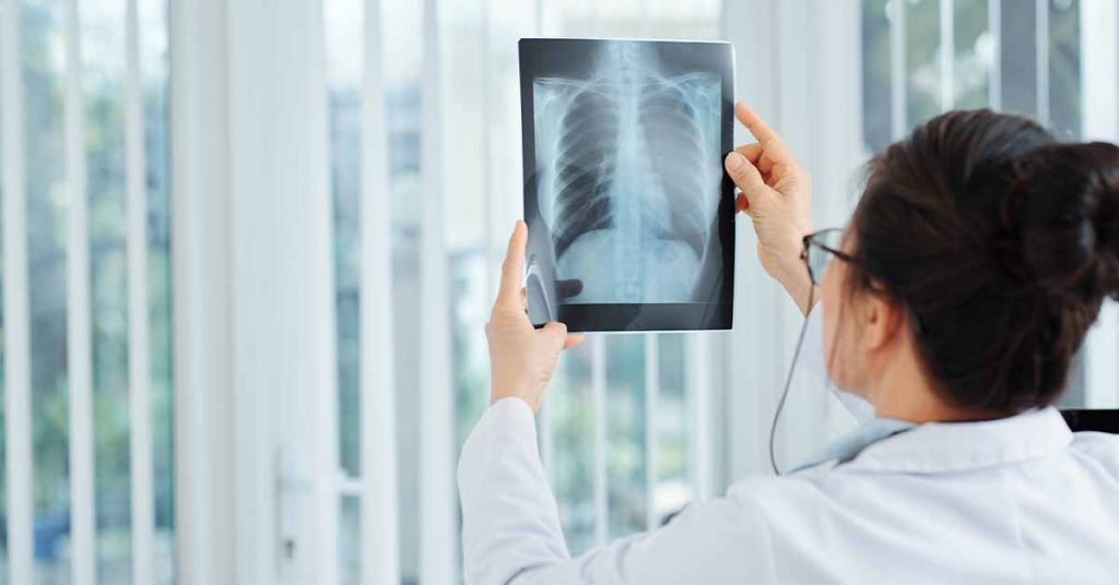 Current Global Lung Cancer Screening Landscape