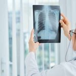 Current Global Lung Cancer Screening Landscape