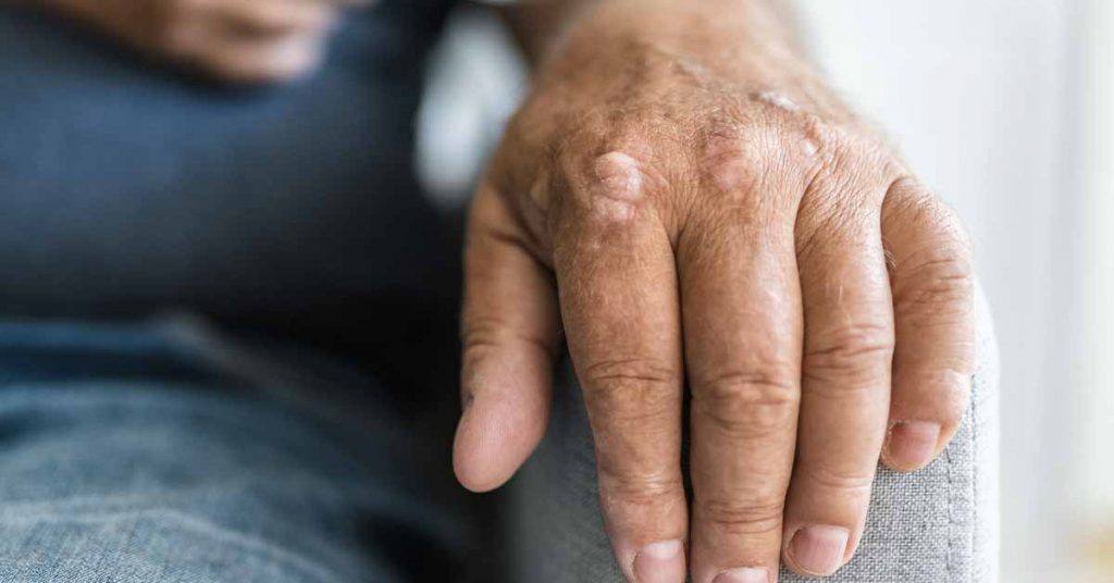 Incident Psoriasis: Associations of Mental Health Issues & Worsened Symptoms