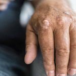 Incident Psoriasis: Associations of Mental Health Issues & Worsened Symptoms