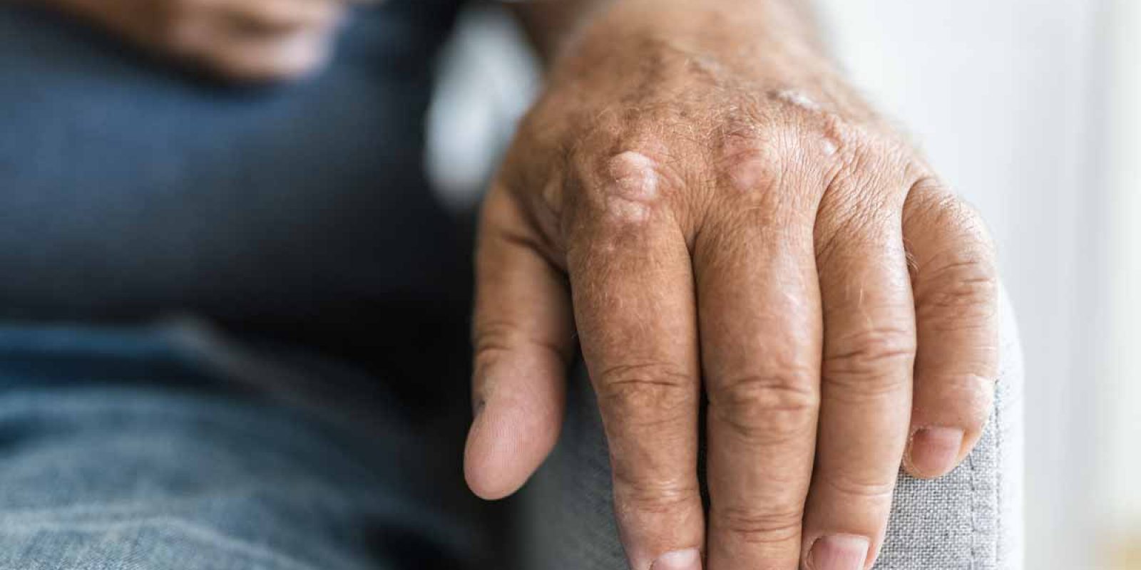 Incident Psoriasis: Associations of Mental Health Issues & Worsened Symptoms