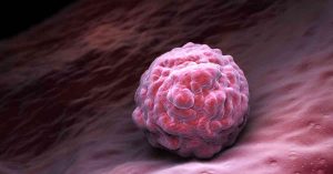 How Some Bone Marrow/Stem Cell Transplants Can Lead to Complications