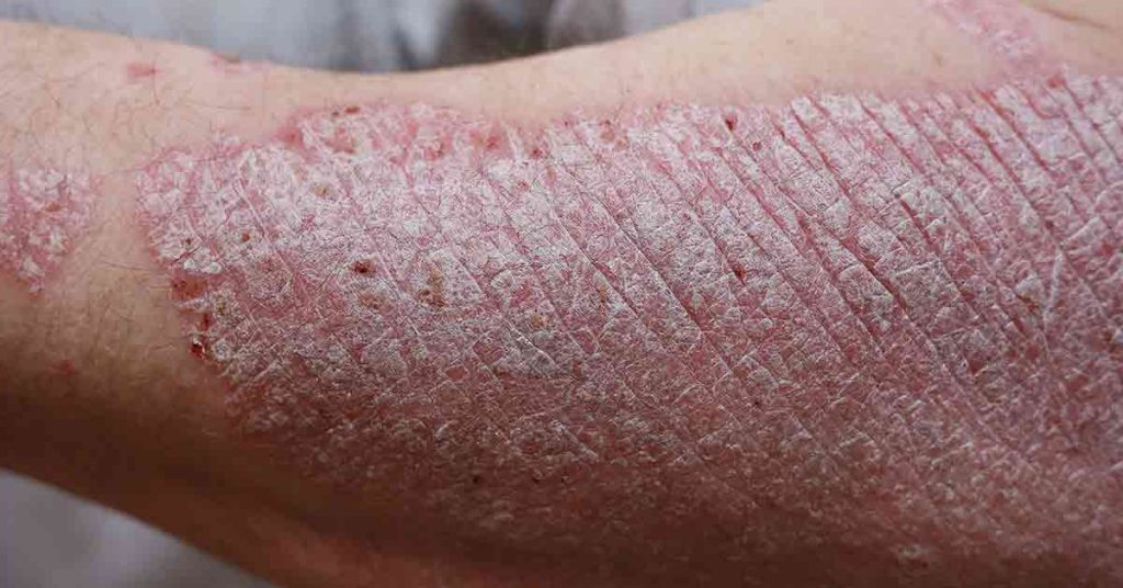 New Data Demonstrates Potential for Oral IL-23 in Psoriasis