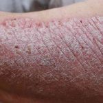 New Data Demonstrates Potential for Oral IL-23 in Psoriasis