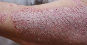 New Data Demonstrates Potential for Oral IL-23 in Psoriasis