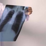 AstraZeneca Reveals Treatment Plus Chemotherapy Reduced Disease Progression by 38% for Advanced NSCLC Patients in FLAURA2 Phase III Trial