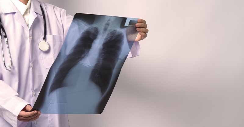 AstraZeneca Reveals Treatment Plus Chemotherapy Reduced Disease Progression by 38% for Advanced NSCLC Patients in FLAURA2 Phase III Trial